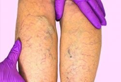 Vein Conditions that May Indicate Vein Disease