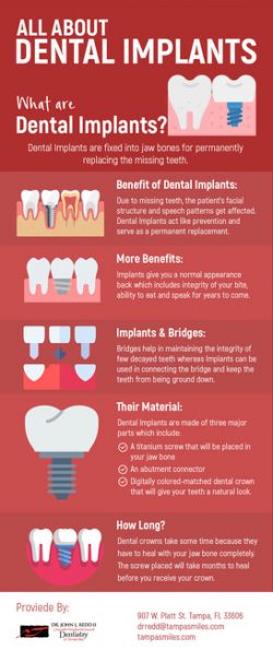 Tampa Smiles – Dental Implant Restorations in Tampa, FL