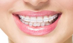 Braces Teeth Alignment Treatments
