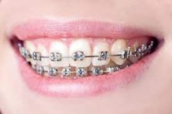 Braces Teeth Alignment Treatments