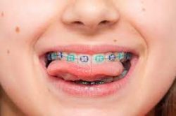 Need Bracket Braces For Childrens