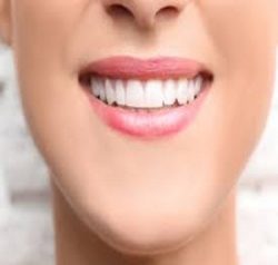 Cosmetic Dental Bonding