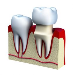 Dental Crown Houston