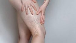 Go through the vein clinics’ offered varicose vein treatments