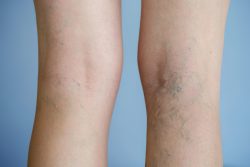 How to Get Rid of Varicose Vein?