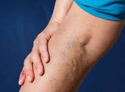 How do I know if I have chronic venous insufficiency?