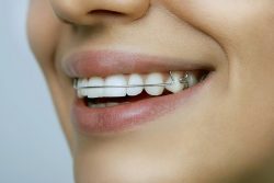 What Is The Clear Retainer Cost?