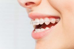 The Best Teeth Straightening Options For Adult