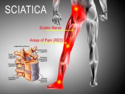 Top 5 Ways on How to Treat Sciatic Nerve Pain