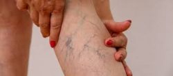 What is the best method of varicose veins treatment?  