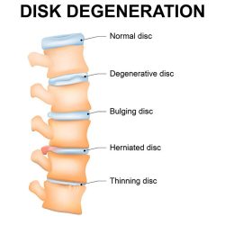 What is Degenerative Disc Disease?