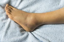 Your notice swelling on one leg or ankle