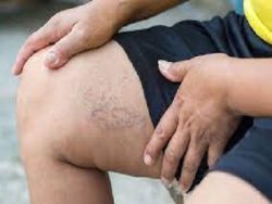 Diagnosis of Varicose Veins and Spider Veins