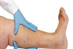 Spider vein removal treatment for spider veins without underlying vein disease
