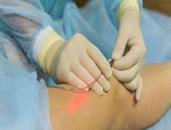 What techniques can my Varicose Vein doctor in Illinois use, to block up my leg veins?