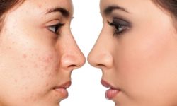 Scar Removal Treatment – Orange Clinic