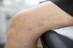 Advanced Spider and Varicose Vein Treatment Clinic
