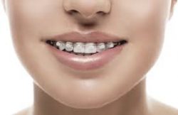 affordable braces near me