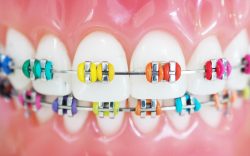 best braces colors