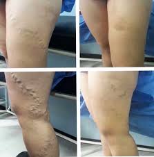 varicose vein