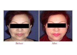 Best Facelift Surgery in Delhi | Dr. Vivek Kumar