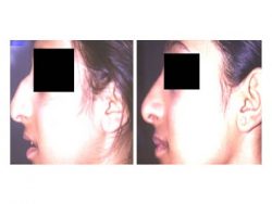 Best Rhinoplasty Surgeon in India | Dr. Vivek Kumar