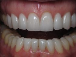 One of The Best Porcelain Veneer Dentist In Houston