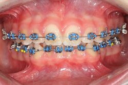 braces colors