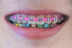 Cute Colors For Braces