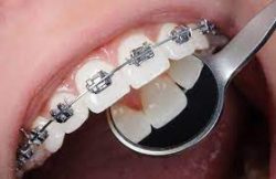 braces near me