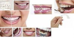 Orthodontist near me free consultation