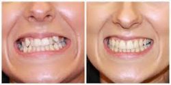 Invisalign locations