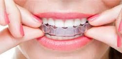 Invisalign Retainer