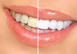 Teeth Whitening Dentist Cost