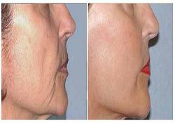 Best Face Lift Surgery in Delhi | Dr. Vivek Kumar