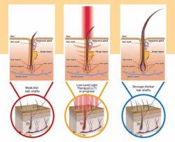 Best Low Level Laser Therapy Treatment With Beauty Recipe In Singapore