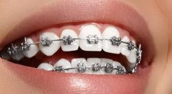 orthodontic braces