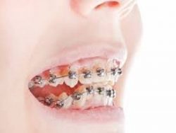 Orthodontist Consultation Aventura North Miami