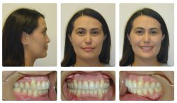 overbite before and after