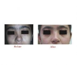 Best Rhinoplasty Surgery in Guwahati | Sculpt India