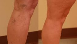 Sclerotherapy Near Me