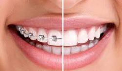 teeth straightening