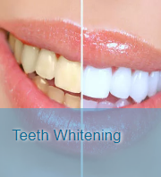 Teeth Whitening Treatment in San Diego