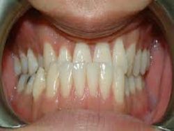 Underbite And Overbite Correction Without Surgery