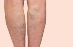 varicose vein treatment