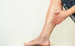 varicose vein treatment