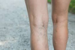 Varicose Vein Treatment SD