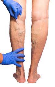 Vein Treatment Center Near Me