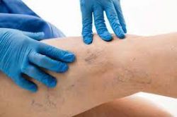 Veins Treatments Near Me