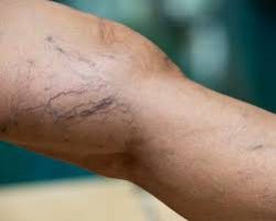 What Causes Spider Veins?